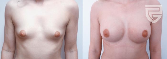 Augmentace prsou - hotový výsledek